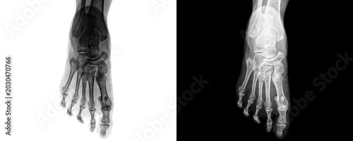 Foto Foot Anterior View X-ray Radiograph Showing Metatarsals Phalanges and Tarsal Bon