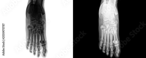 Bild auf Leinwand Diagnostic Medical Foot Anterior View X-ray Showing Metatarsal and Phalangeal Bo