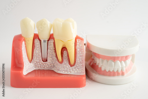 Fotografía Dental implant, artificial tooth roots into jaw, root canal of dental treatment, gum disease, teeth model for dentist studying about dentistry