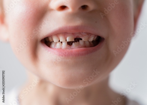 Foto Close up portrait of a smiling child with missing baby tooth