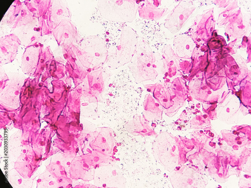 Tableau sur toile High Vaginal Swab (HVS) for gram stain