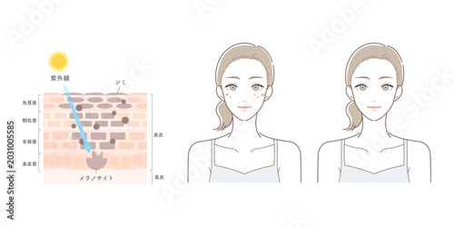 Bild auf Leinwand 紫外線によるシミ発生の仕組みとメラニン生成の比較イラスト（光老化・肌断面図）