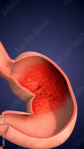 Digestive Disorder Gastroesophageal Reflux Disease Animation