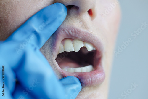 Close-up view of dental examination with a gloved hand checking inside mouth