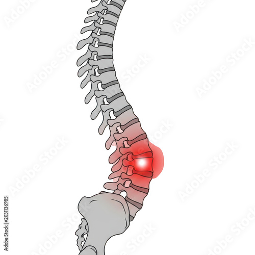 Slipped disc illustration with pain in lumbar region isolated on transparent background for medical, health, and anatomy content