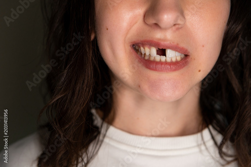 Foto Mature caucasian woman shows emotion after losing a front tooth and prepares for