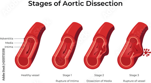 Bild auf Leinwand Stages of Aortic Dissection Medical Design Vector Illustration