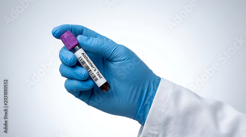 Medical professional wearing blue nitrile glove holding a blood sample vial for Alzheimer s disease diagnostic testing
