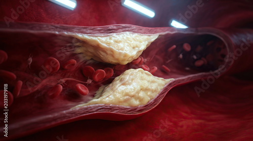 Atherosclerosis causes plaque buildup inside artery walls reducing blood flow and increasing risk of heart disease with red blood cells and damaged vessel tissue visible this medical illustration