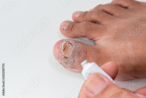 Detailed Toenail Fungus Care and Cleaning Process