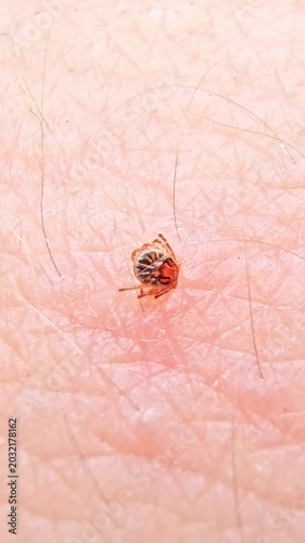 Extreme close up of a mite walking on human skin. This blood sucking arachnid is a disease vector for serious infectious illnesses like lyme disease