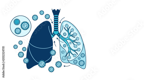 Schilderij op canvas Medical illustration of human lungs infected by viruses and bacteria
