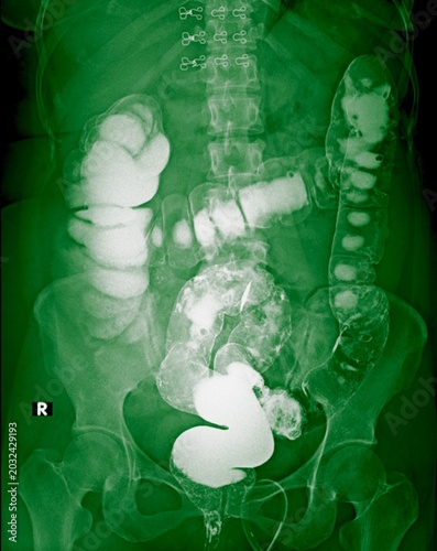 Barium enema X-ray showing a colon polyp in the descending colon, medical imaging of colorectal neoplasm