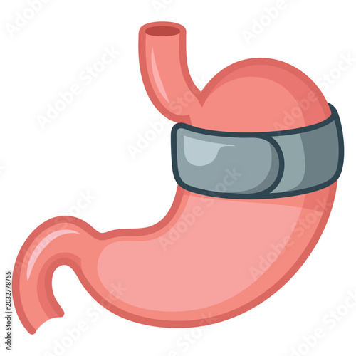 Adjustable gastric band isolated on white background. Stomach banding vector illustration ideal for healthcare and bariatric surgery themes.