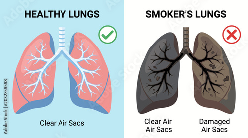 Fotografía Lungs Comparison Healthy vs Smoker for Medical Infographic