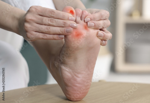 Fotografie Woman with calluses on her foot at home, closeup