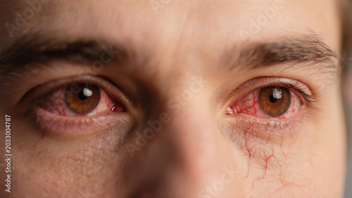 Keratitis is a common inflammatory eye disease that affects the cornea, often causing redness, soreness, blurred vision and eye irritation. Caused by bacterial, viral or fungal infections and external