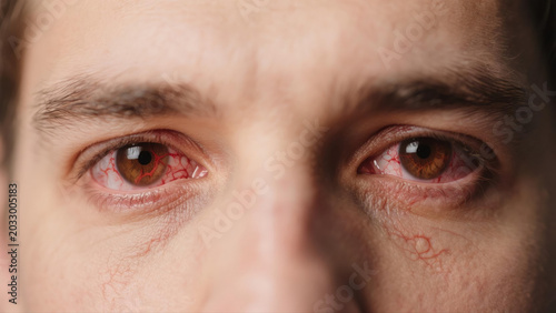 Keratitis is a common inflammatory eye disease that affects the cornea, often causing redness, soreness, blurred vision and eye irritation. Caused by bacterial, viral or fungal infections and external