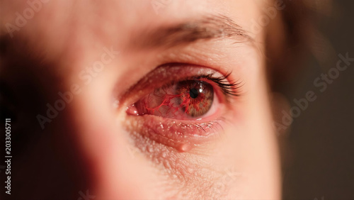 Keratitis is a common inflammatory eye disease that affects the cornea, often causing redness, soreness, blurred vision and eye irritation. Caused by bacterial, viral or fungal infections and external