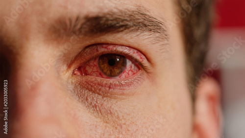 Keratitis is a common inflammatory eye disease that affects the cornea, often causing redness, soreness, blurred vision and eye irritation. Caused by bacterial, viral or fungal infections and external