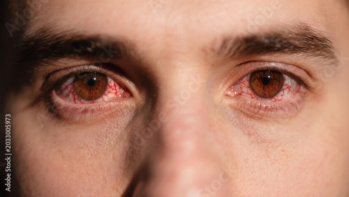 Keratitis is a common inflammatory eye disease that affects the cornea, often causing redness, soreness, blurred vision and eye irritation. Caused by bacterial, viral or fungal infections and external