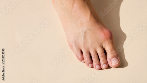 woman foot with hallux valgus deformity showing bunion on big toe joint. Concept of orthopedic disorder and podiatry treatment. Medical condition of human skeletal bone structure