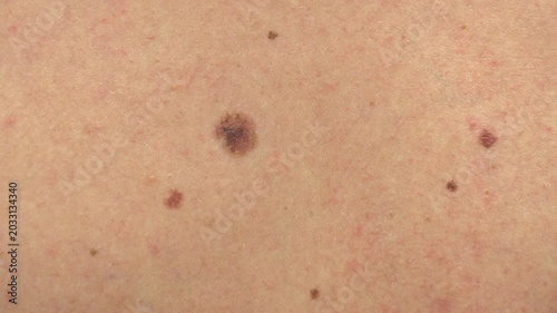 Oncology clinic. Warts on human skin. Skin cancer screening. Papillomas on human skin.