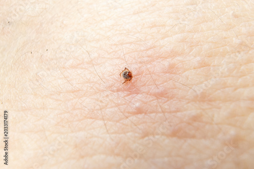 Tableau sur toile close up of a blood sucking tick biting into human skin