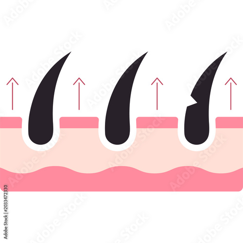 Foto Hair Removal Illustration