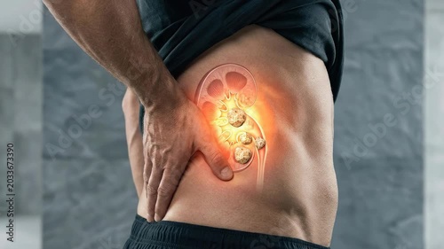 Urological tract distress: kidney stone, acute pain, renal problem, organ discomfort, calculus formation, human ache, urolithiasis disease, body ailment.