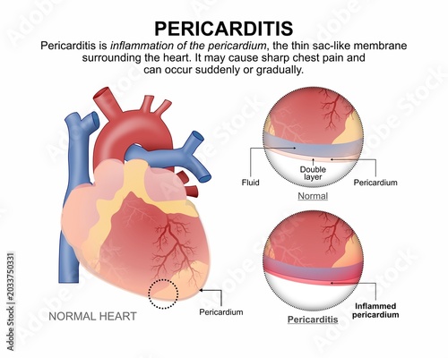 Pericarditis, Inflammed Pericardium, Heart Flashcard Illustration