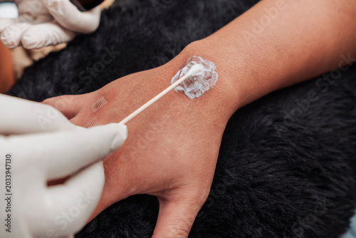 Bilde på lerret Closeup of topical ointment being applied to treated keloid scars on a hand after a fractional carbon laser procedure at an esthetic clinic