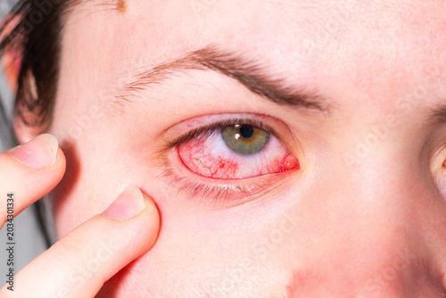 Photos Conjunctivitis making eye bloodshot and swollen