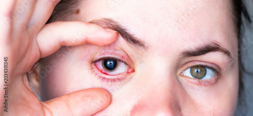 Quadro su tela Conjunctivitis making eye bloodshot and swollen