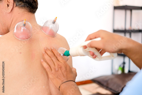 Fotografía Tarditional Chinese treatment blood cuping theraphy  on back reduce back pain  s