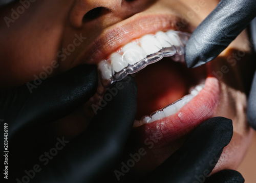 Photography Las manos de dentista colocando alineadores invisibles en boca de mujer