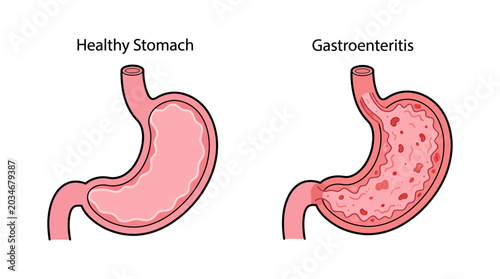 Bild auf Leinwand Healthy Stomach vs Gastroenteritis Inflammation Medical Illustration
