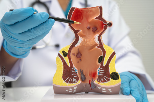 Φωτογραφία Asian doctor with rectum and hemorrhoid human model, inflamed vascular structure