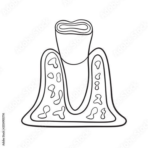 Tooth erosion Illustration