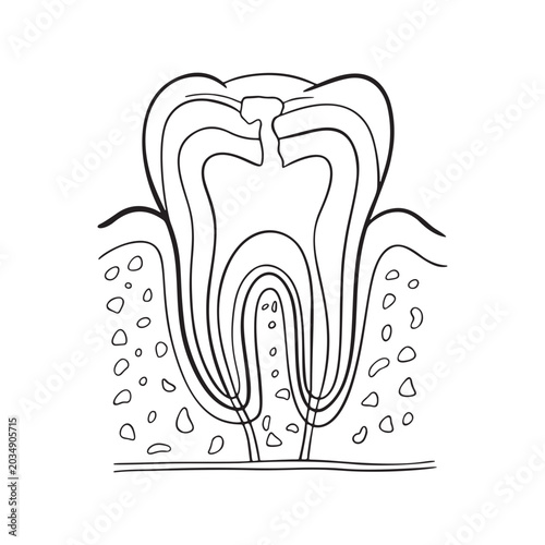 Tooth necrosis Illustration