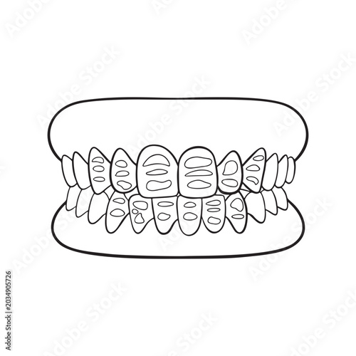 Dental fluorosis Illustration
