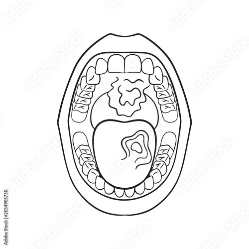 Oral cancer Illustration