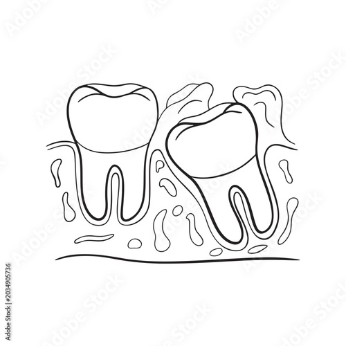 Pericoronitis Illustration