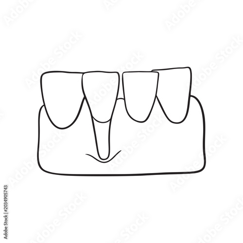 Receding Gums Illustration