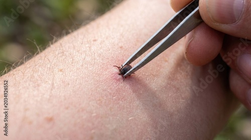 A person removing an attached tick from the skin with tweezers, with redness around the bite site, the risk of infection, disease transmission and the need to raise awareness about outdoor health.