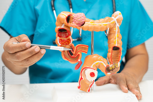 Colorectal cancer, doctor holding intestine colon human anatomy model.