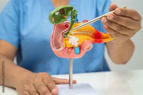Pancreatitis, pancreatic cancer, Asian doctor with pancreas, gallbladder and bile duct human anatomy model at hospital.