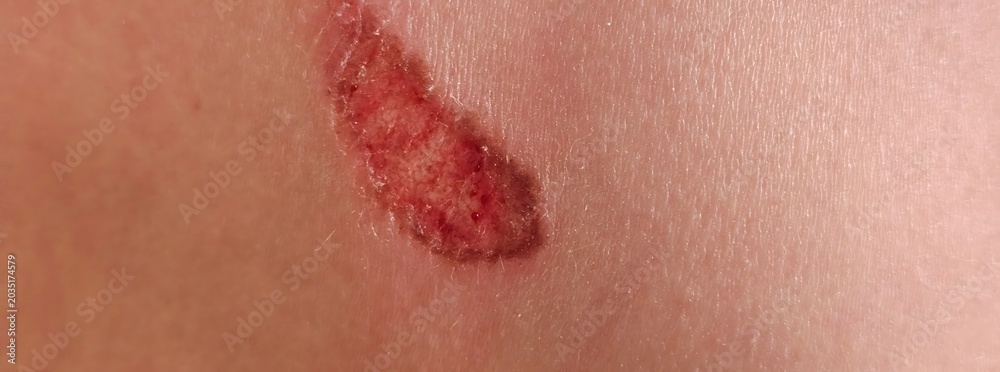 Fototapeta premium Skin injury showing redness and swelling indicating possible abrasion on the body skin surface