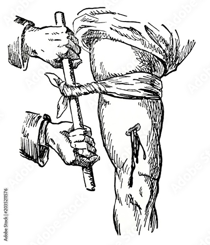 Foto Vintage woodcut illustration of a stick tourniquet application