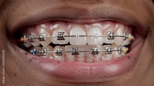 Close up of teeth with metal dental braces.